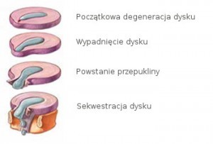 Przepuklina dysku kręgosłupa