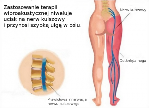 Rwa kulszowa leczenie Vitafonem